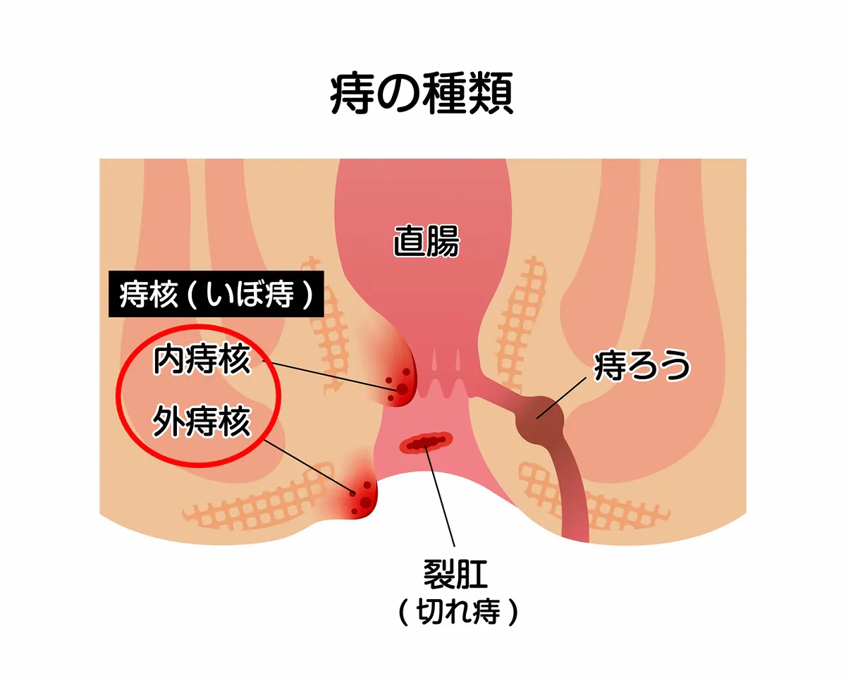 いぼ痔（痔核）について