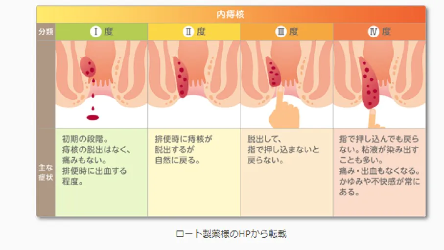 内痔核の分類