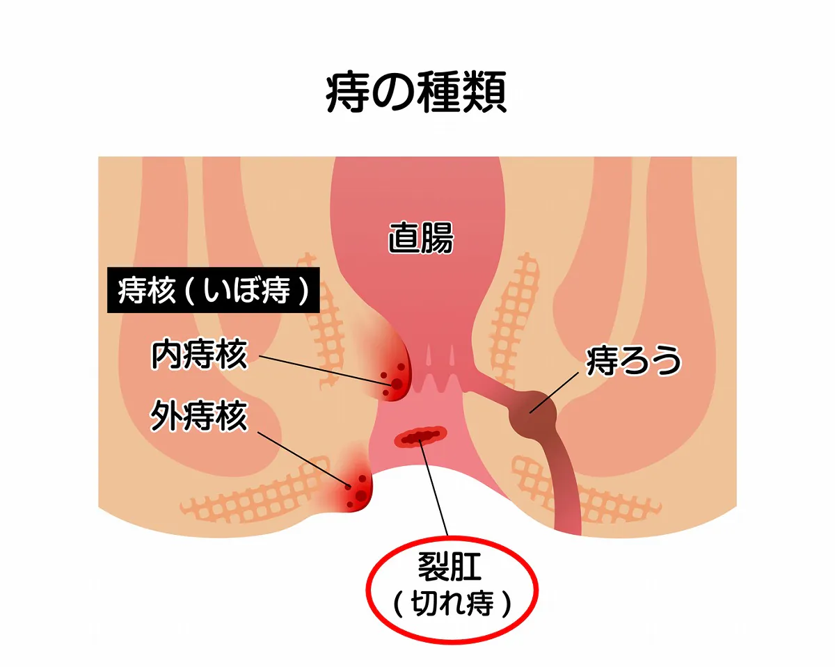 切れ痔（裂肛）について