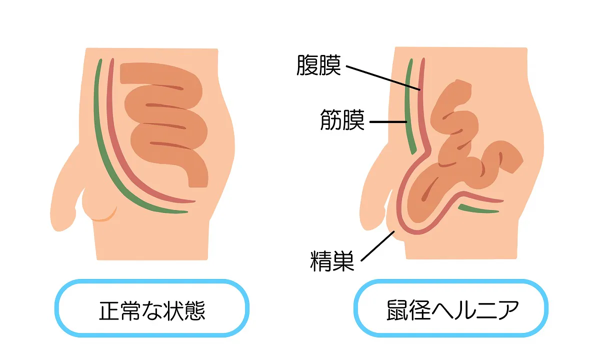 下腹部の足付け根あたりにぽっこり膨らみ！？鼠径ヘルニアとは