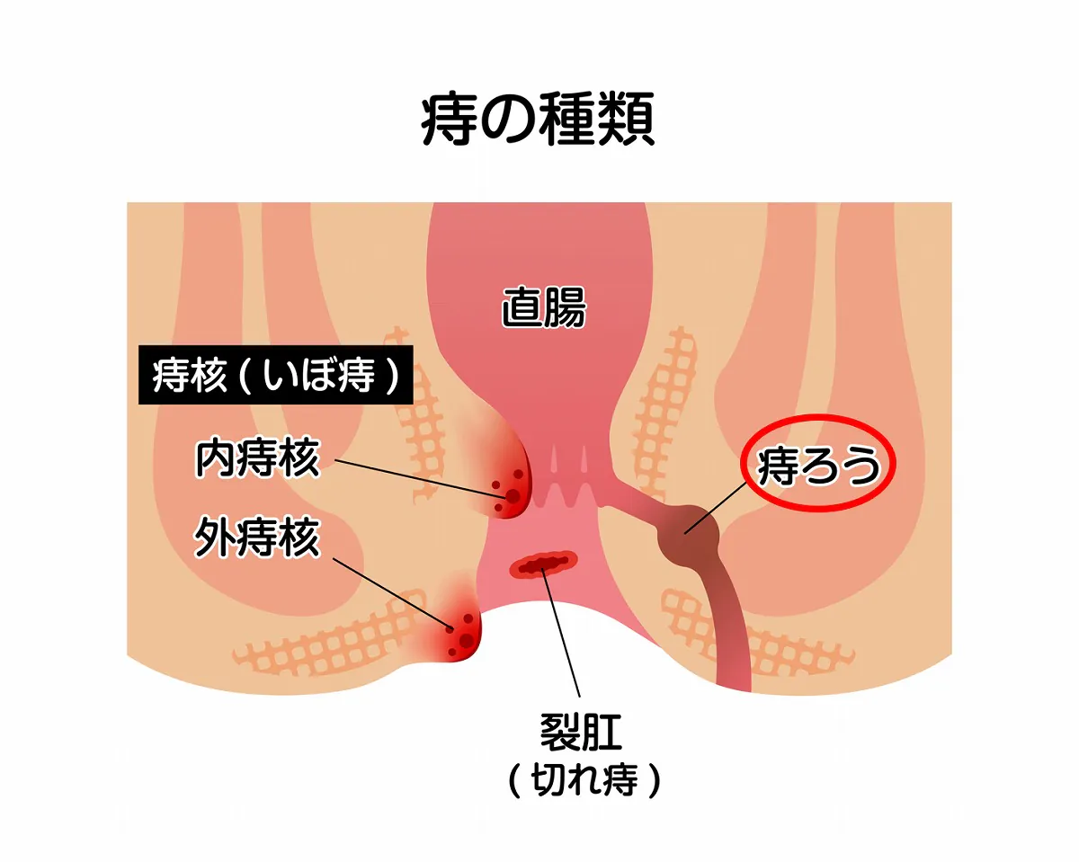 あな痔（痔瘻）とは