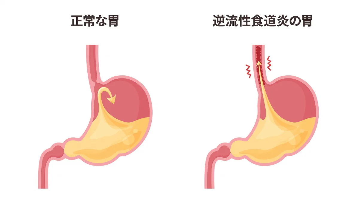 逆流性食道炎の主な原因