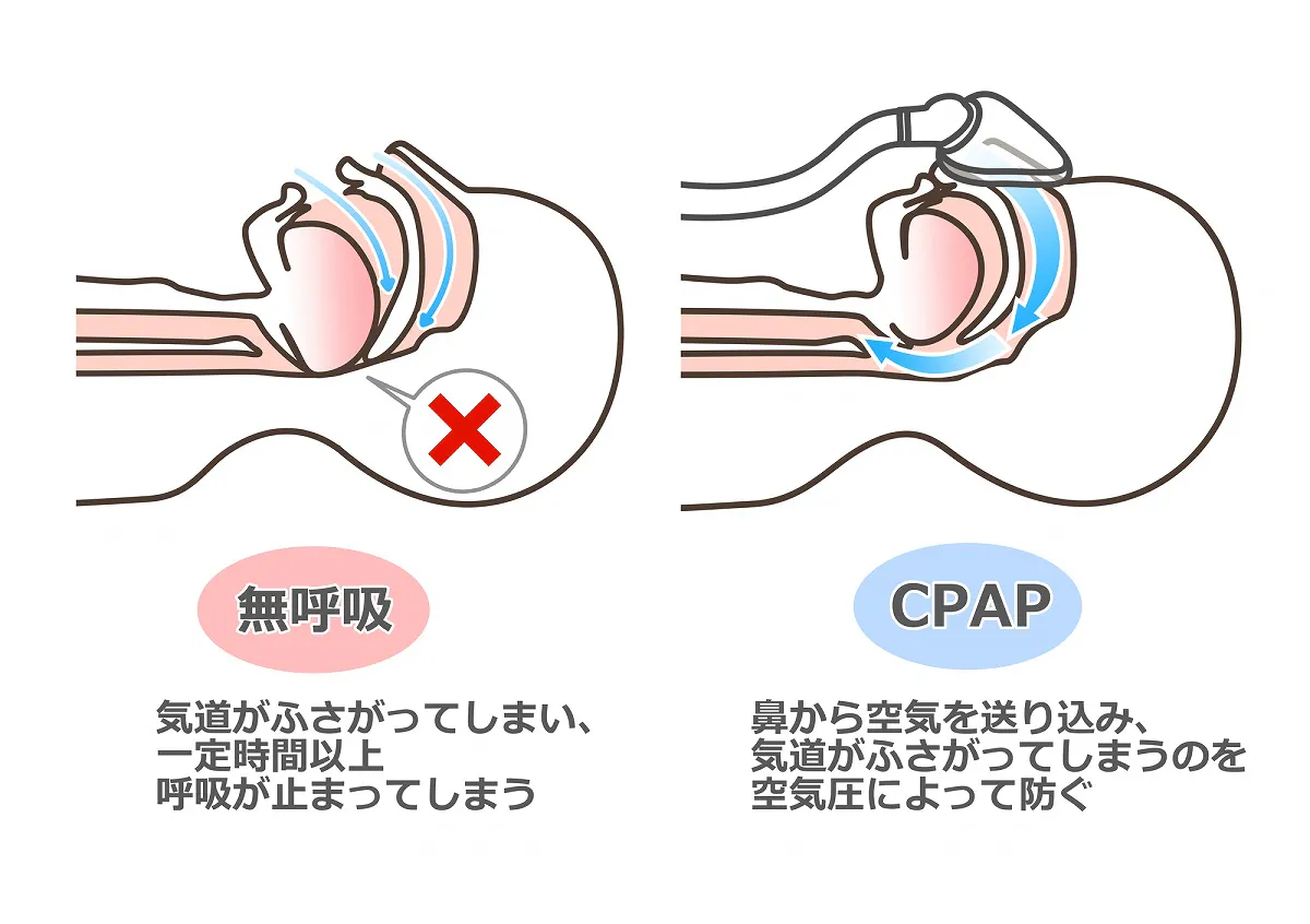 睡眠時無呼吸症候群の治療